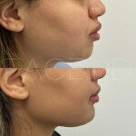 Subtle and beautiful result for facial harmonization with chin implant