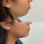 Chin implant result after 3.5 months for this beautiful patient