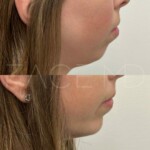 Beautiful natural result of chin implant on this patient