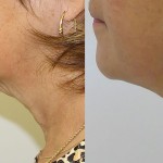 Source: Dr. Moubayed’s practice. Not a guarantee of results. Photos published with informed written consent of patients Female treated with Evoke to neck
