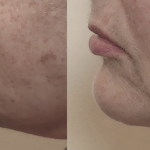 Source: Dr. Moubayed’s practice. Not a guarantee of results. Photos published with informed written consent of patients Female treated with Evoke to neck