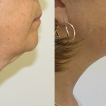 Source: Dr. Moubayed’s practice. Not a guarantee of results. Photos published with informed written consent of patients