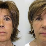Source: Dr. Moubayed’s practice. Not a guarantee of results. Photos published with informed written consent of patients Female treated with Evoke to neck