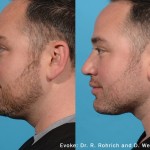 Source: Dr. Moubayed’s practice. Not a guarantee of results. Photos published with informed written consent of patients Male treated with Evoke to neck
