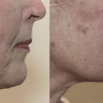 Source: Dr. Moubayed’s practice. Not a guarantee of results. Photos published with informed written consent of patients Female treated with Evoke to neck