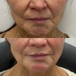Right after injection the lips for a subtle refreshed look, augmentation of the chin with fillers and nasolabial folds.