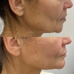 Right after injection the lips for a subtle refreshed look, augmentation of the chin with fillers and nasolabial folds.