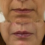 Augmentation du menton avec augmentation des lèvres