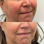Almost invisible scar at 5 months after a lip lift. You can see how the lip flips upwards more naturally after the intervention.