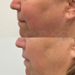 Almost invisible scar at 5 months after a lip lift. You can see how the lip flips upwards more naturally after the intervention.