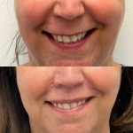 Almost invisible scar at 5 months after a lip lift. You can see how the lip flips upwards more naturally after the intervention.