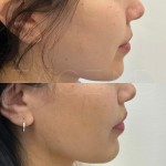 After only 3 months, the lip lift scar is almost invisible. The top lip is lifted and the proportions are in harmony.