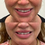 Lip lift results after only 3 months of healing. The distance between the top part of the lip to the bottom of the nose is shorter and the asymmetry has also been corrected.