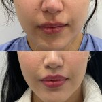 After only 3 months, the lip lift scar is almost invisible. The top lip is lifted and the proportions are in harmony.