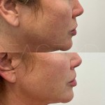 Lip lift results after only 3 months of healing. The distance between the top part of the lip to the bottom of the nose is shorter and the asymmetry has also been corrected.