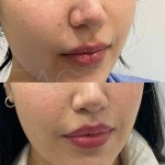 After only 3 months, the lip lift scar is almost invisible. The top lip is lifted and the proportions are in harmony.