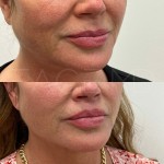 Lip lift results after only 3 months of healing. The distance between the top part of the lip to the bottom of the nose is shorter and the asymmetry has also been corrected.