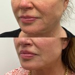 Lip lift results after only 3 months of healing. The distance between the top part of the lip to the bottom of the nose is shorter and the asymmetry has also been corrected.