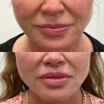 Lip lift results after only 3 months of healing. The distance between the top part of the lip to the bottom of the nose is shorter and the asymmetry has also been corrected.