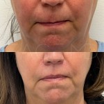 Almost invisible scar at 5 months after a lip lift. You can see how the lip flips upwards more naturally after the intervention.