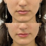 Amélioration subtile des lèvres à Clinique Face MD