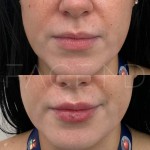 Augmentation et définition des lèvres avec l'acide hyaluronique sur cette belle patiente.