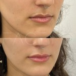 Amélioration subtile des lèvres à Clinique Face MD