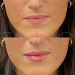 Amélioration subtile mais magnifique en une seule séance pour repulper les lèvres et définir le contour.