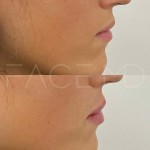 Amélioration subtile mais magnifique en une seule séance pour repulper les lèvres et définir le contour.