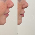 Augmentation et définition des lèvres avec l'acide hyaluronique sur cette belle patiente.
