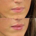 Amélioration subtile mais magnifique en une seule séance pour repulper les lèvres et définir le contour.