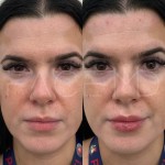 Augmentation et définition des lèvres avec l'acide hyaluronique sur cette belle patiente.