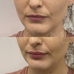 Définition subtile des lèvres et hydratation à la clinique Face MD