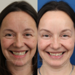 Source: Dr. Moubayed’s practice. Not a guarantee of results. Photos published with informed written consent of patients Female treated with botox to frown lines, crow's feet and forehead