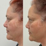 Fine lines reduced, better skin texture, tightened under chin area and jowls
