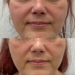 Fine lines reduced, better skin texture, tightened under chin area and jowls