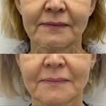 Fine lines reduced, better skin texture, tightened under chin area and jowls