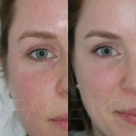 Neuromodulators to soften the wrinkles around the eyes and lift the brow