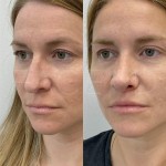 Only 2 months after rhinoplasty and already seeing great results! Nose is straighter, has a new orientation and a more defined tip.