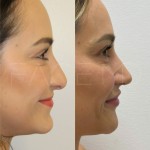 Only 2 months after a revision rhinoplasty, patient can breath better and her nose is more projected. The swelling will go down over the next year and the definition will also continue to appear.