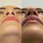 Only 2 months after a revision rhinoplasty, patient can breath better and her nose is more projected. The swelling will go down over the next year and the definition will also continue to appear.