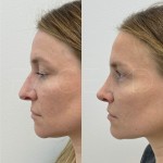 Only 2 months after rhinoplasty and already seeing great results! Nose is straighter, has a new orientation and a more defined tip.