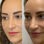 Only 2 months after a revision rhinoplasty, patient can breath better and her nose is more projected. The swelling will go down over the next year and the definition will also continue to appear.