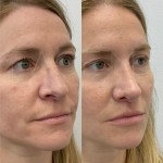 Only 2 months after rhinoplasty and already seeing great results! Nose is straighter, has a new orientation and a more defined tip.