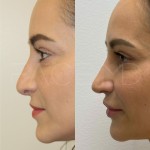 Only 2 months after a revision rhinoplasty, patient can breath better and her nose is more projected. The swelling will go down over the next year and the definition will also continue to appear.