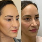 Only 2 months after a revision rhinoplasty, patient can breath better and her nose is more projected. The swelling will go down over the next year and the definition will also continue to appear.