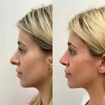 Beautiful patient just 3 months after revision rhinoplasty, can now breath better and the shape will continue to refine over the neck year.