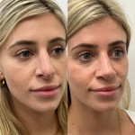 Beautiful patient just 3 months after revision rhinoplasty, can now breath better and the shape will continue to refine over the neck year.