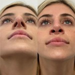 Beautiful patient just 3 months after revision rhinoplasty, can now breath better and the shape will continue to refine over the neck year.
