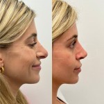 Beautiful patient just 3 months after revision rhinoplasty, can now breath better and the shape will continue to refine over the neck year.